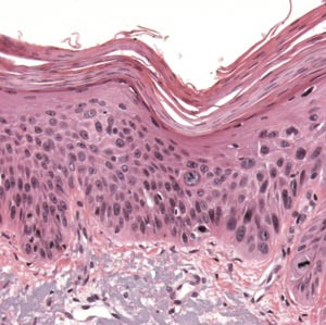 Figur 2  Aktinisk keratose med atypisk epitelproliferasjon i nedre og midtre del av epidermis. P&aring; overflaten er det lett&hellip;