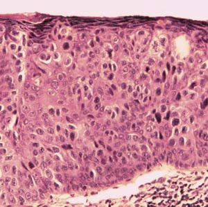 Figur 3  Carcinoma in situ i hud. Det er fullstendig opphevet lagdeling og modning, men basalmembranen er intakt