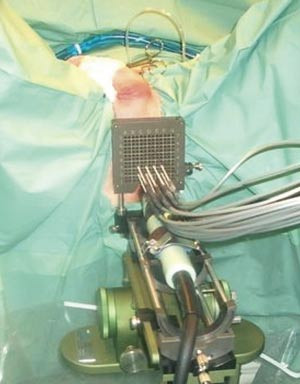 Figur 2  Brakystand med ultralydsonotrode (med sort kabel) plassert i rectum og n&aring;ler som g&aring;r inn i prostata via templat&hellip;