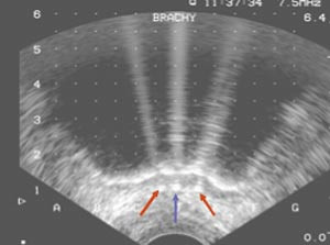 Figur 4  Sonografisk tverrsnitt under frysing av prostata. Bildet viser isballens ekspansjon (sort sone) mot rectum. I&hellip;
