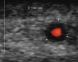 Figur 1  Tverrsnitt av tinningarterien (energidoppler) hos 74 &aring;r gammel kvinne med positiv temporalisbiopsi: blodf&oslash;rende&hellip;