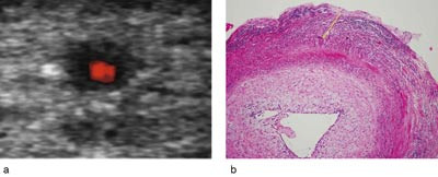 Figur 2  a) Tverrsnitt av tinningarterien (energidoppler) med halo hos 66 &aring;r gammel kvinne. b) Histologisk bilde fra&hellip;