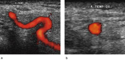 Figur 3  Normal tinningarterie uten halo (energidoppler) hos pasient med negativ temporalisbiopsi. a) Lengdesnitt og b)&hellip;