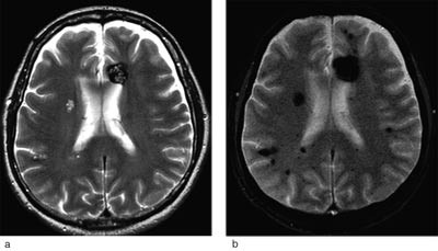 Figur 2 MR-skanning av caput hos en 55 &aring;r gammel mann med cerebrale kavern&oslash;se malformasjoner. a) Transversal turbospinnekko&hellip;