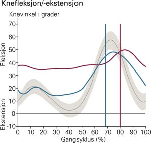 Kinematiske knekurver i sagittalplan fra h&oslash;yre bein. Horisontal r&oslash;d kurve er preoperativt, bl&aring; kurve er postoperativt. De&hellip;