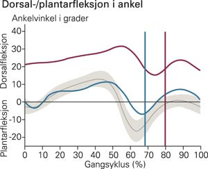 Kinematiske ankelkurver i sagittalplan fra h&oslash;yre bein. Horisontal r&oslash;d kurve er preoperativt, bl&aring; kurve er postoperativt. De&hellip;