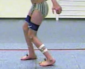 Figur 4 Pasienten gikk preoperativt med korte skritt og hadde &oslash;kt fleksjon i kn&aelig;r og hofter og &oslash;kt dorsalfleksjon i ankler &hellip;