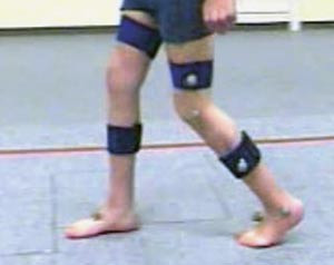 Figur 5 Pasienten ett &aring;r etter operasjon. Han g&aring;r med lengre skritt, og det er bedre utretting i kn&aelig;r og hofter i&hellip;