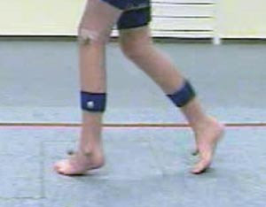 Figur 6 Pasient 2 gikk preoperativt med innoverdreid spissfotstilling av venstre fot