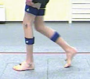 Figur 8 Pasient 2 ett &aring;r etter operasjonen. Han tr&aring;kker n&aring; helt ned p&aring; venstre fot, og fotens vinkel i transversplanet synes&hellip;