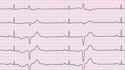 Figur 3 EKG av pasient 2 ved innkomst viste bradykardi og ekstrasystoli. QT-tiden ble vurdert som forlenget, men lot seg&hellip;
