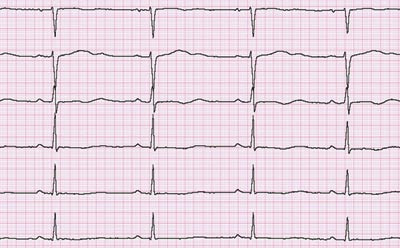 Figur 4 Tydelig forlenget QT-tid p&aring; EKG av pasient 2 noen dager etter innkomst. Korrigert QT-tid (QTc) var 562 ms