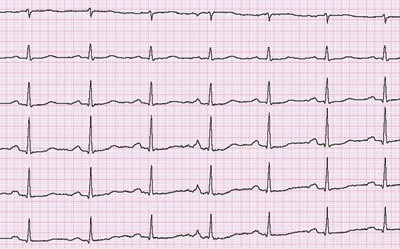 Figur 5 EKG etter seponering av metadon hos pasient 2 viste kortere QT-tid med korrigert QT-tid 457 ms