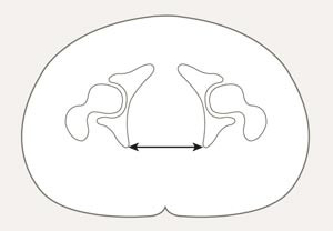 Aksialt snitt sentrert over caput fovea. Her m&aring;les interspinaldiameter