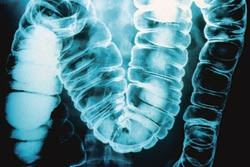 Det er uavklart om statiner reduserer risiko for tykktarmskreft. Foto Corbis/SCANPIX