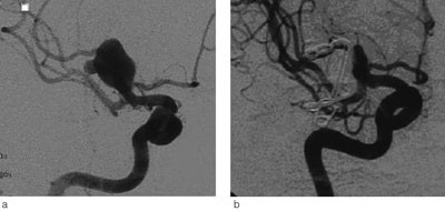 Figur 1  En 62 &aring;r gammel mann med kjent hypertensjon ble unders&oslash;kt med CT p&aring; grunn av forbig&aring;ende iskemiske symptomer fra&hellip;