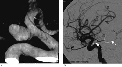Figur 2  48 &aring;r gammel mann med alvorlig subaraknoidalbl&oslash;dning (Hunt & Hess-grad IV og Fisher-grad 4) fra et stort aneurisme&hellip;