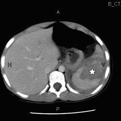 Figur 1  CT-bilde av miltskade grad 4 hos 10 &aring;r gammel gutt. Sentralt i milten (merket med stjerne) ses et stort&hellip;