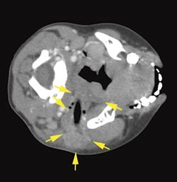 Figur 1  Aksial CT-unders&oslash;kelse i h&oslash;yde med mandibula viser luft parafaryngealt p&aring; venstre side