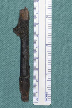 Figur 2  En kvist som m&aring;lte 8,5 cm, ble fjernet ved det kirurgiske inngrepet