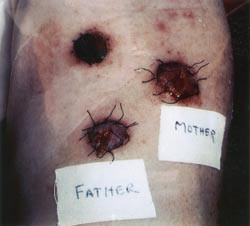 Figur 2  Bildet viser underarmen til Ole Jacob Malm med tre transplanterte hudlapper, en fra den nyresyke pasienten, en fra&hellip;