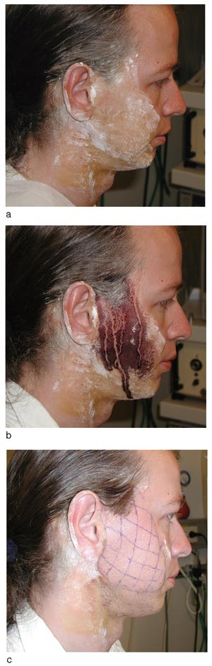Figur 1  Kolorisk svettetest som beskrevet av Minor i 1927. a) Jodl&oslash;sning blir penslet p&aring; og f&aring;r t&oslash;rke. Stivelse pensles&hellip;