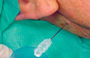 Figur 1  Innstikksstedet er p&aring; den kontralaterale siden til smerten, mellom ryggvirvlene C1 og C2