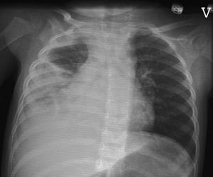 Figur 4  R&oslash;ntgen thorax av pasient 1 ved andre innleggelse. Infiltrat basalt i h&oslash;yre lunge og pleurav&aelig;ske p&aring; h&oslash;yre side
