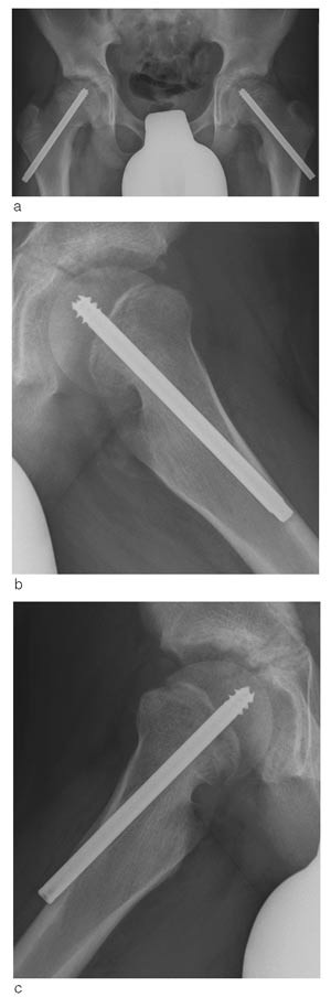Figur 2  Pasient behandlet for bilateral epiphysiolysis capitis femoris med en spesialkonstruert Olmed-skrue