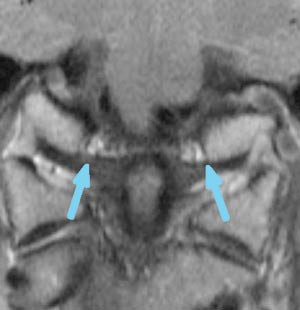 Figur 2  MR-bilde av kraniocervikalovergangen i koronalplan. Piler p&aring; alarligamentene som g&aring;r fra dens axis til&hellip;