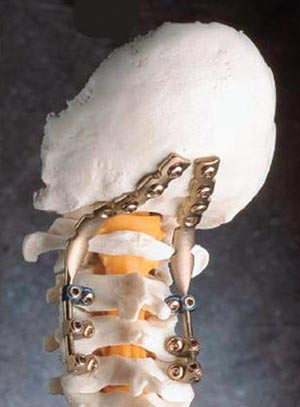 Figur 3  Kraniocervikal fiksasjon med stag og skruer i bakhodebeinet, gjennom leddene C1/C2 og i lateralmassivene C3&thinsp;&ndash;&thinsp;C4