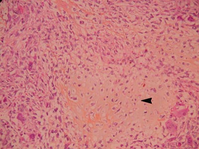 Figur 2  Fra lungemetastasen. Atypisk cellerikt mesenkym med kondroid differensiering (pil)