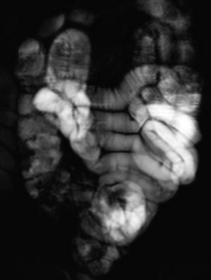 Figur  1   Koronal SST2WTSE. Sondeunders&oslash;kelse. Dynamisk serie som viser v&aelig;skepassasjen i tynntarmen. Vi f&oslash;lger v&aelig;skes&oslash;ylen,&hellip;