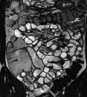 Figur 3  Koronal B-FFE. MR med oral kontrast. Det foreligger d&aring;rlig utvidelse av proksimale tynntarm
