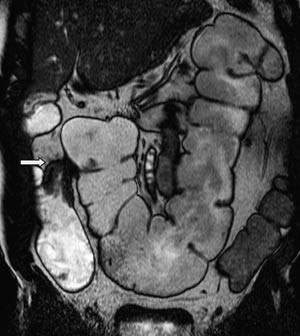 Figur 5  Koronal B-FFE. &laquo;Drikkeunders&oslash;kelse&raquo; hos 63 &aring;r gammel mann med Crohns sykdom uten kliniske tegn p&aring; aktiv sykdom&hellip;