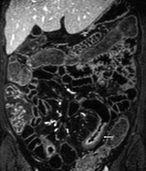 Figur 7  Koronal 3D T1-vektet sekvens med fettsuppresjon etter intraven&oslash;s kontrast. Sondeunders&oslash;kelse. 36 &aring;r gammel kvinne&hellip;