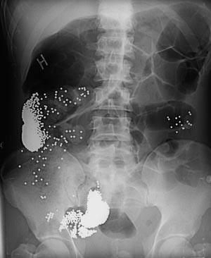 Figur 2  R&oslash;ntgen oversikt abdomen hos pasient 2 tatt to dager etter innleggelsen