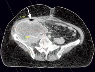 Figur 3  Implantert protese etter reseksjon av tumor. Markerte str&aring;lefelter (gr&oslash;nne linjer) og m&aring;lvolum (r&oslash;d linje)&hellip;