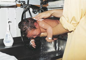 Figur 3  &Oslash;yepuss kunne skyldes at barn ble dusjet og fikk s&aring;pevann i &oslash;ynene. Foto Helene Pande