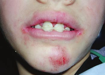 Figur 4  Tannen fikseres hos tannlege, i 7&thinsp;&ndash;&thinsp;10 dager. Her er det benyttet hvitt tannfyllingsmateriale (kompositt)