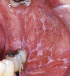 Figur 4  Retikul&aelig;r oral lichen planus. Foto Bjarte Grung