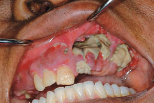 Figur 2  Blottlagt nekrotisk overkjevebein i en pasient som er behandlet med et bisfosfonat (zolodronat) i seks m&aring;neder&hellip;