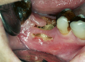 Figur 2  Osteonekrose i mandibelen etter ekstraksjon av tann 46 hos brystkreftpasient med skjelettmetastaser under&hellip;