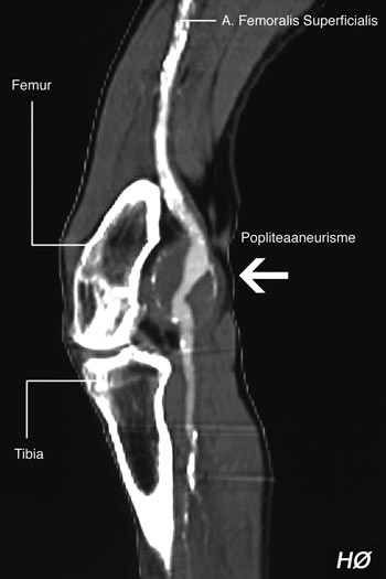 Figur 2  H&oslash;yresidig popliteaaneurismer uten ruptur