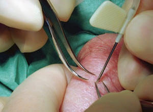 Figur 2  Testikul&aelig;r spermieaspirasjon (testicular sperm aspiration, TESA). Testikkelvev aspireres til en sommerfugln&aring;l &hellip;