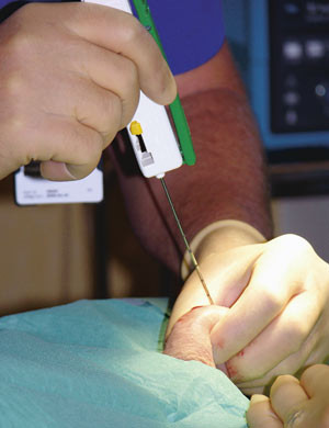 Figur 3  Perkutan n&aring;lebiopsi for uthenting av testikkelvev ved azoospermi. Ved bruk av en biopsin&aring;l f&aring;r man ut testikkelvev&hellip;