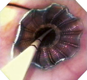 Figur 2  Endoskopisk bilde av innlagt stent med introduser. &copy; Boston Scientific Corporation, gjengitt med tillatelse
