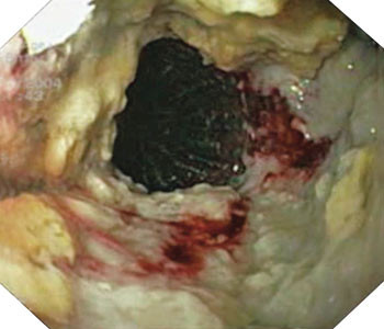 Figur 3  Innvekst/overvekst i en Ultraflex oesophagusstent