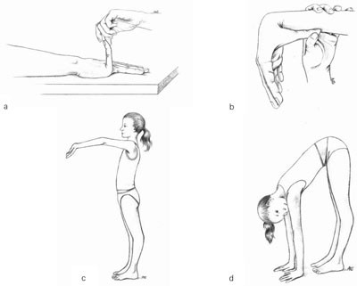 Figur 2  Beightons skala for unders&oslash;kelse av hypermobilitet (15). a = lillefingertegn, b = tommeltegn, c = hyperekstensjon&hellip;