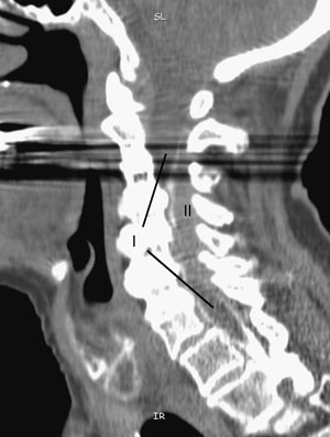 Figur 3  Hematomet (II) ses bak ryggmargen (I) opp til C2/C3-niv&aring;. Snittplanet ligger til h&oslash;yre for midtlinjen, derfor er&hellip;